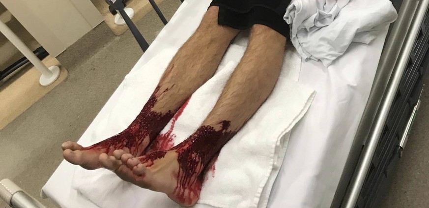 In this picture taken Saturday, Aug. 5, 2017 at the waiting room of Sandringham Hospital in Melbourne, teenager Sam Kanizay lays in a bed with his feet bleeding. A teenager who went for a swim at a Me ...