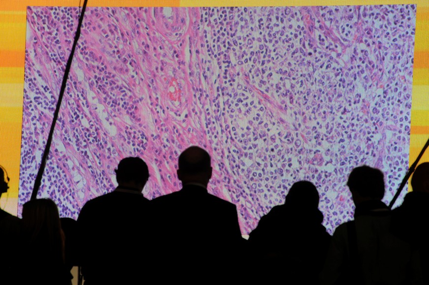 Cancer cells are seen on a large screen connected to a microscope at the CeBit computer fair in Hanover, Germany, March, 6, 2012. To match Insight HEALTH-CANCER/IMMUNOTHERAPY REUTERS/Fabian Bimmer/Fil ...