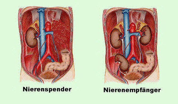 Schema Nierentransplantation