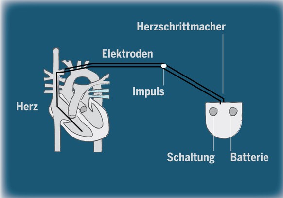 Der Herzschrittmacher stimuliert den Herzmuskel regelmässig mit elektrischen Impulsen und regt diesen so zur Kontraktion an. 1958 wurde der erste Herzschrittmacher eingesetzt. Mittlerweile lassen sich ...
