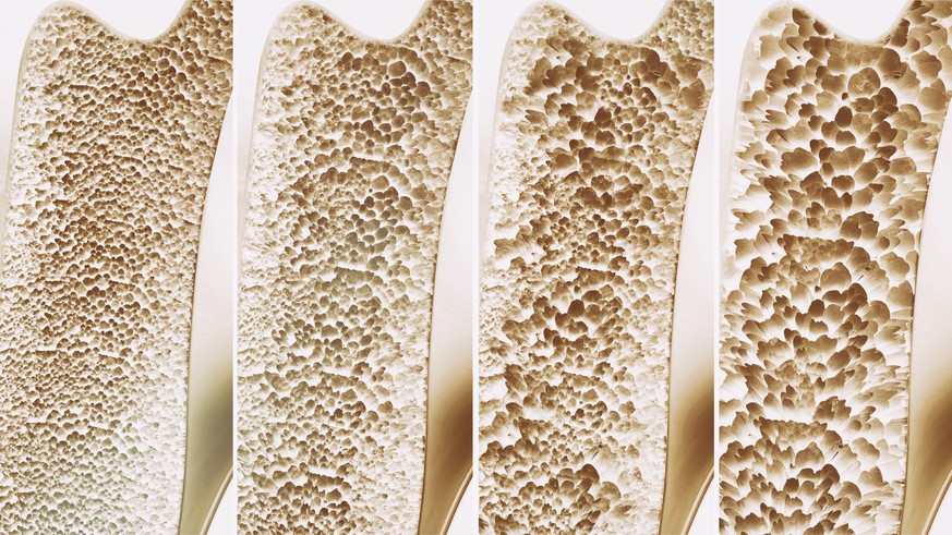 Osteoporose in verschiedenen Stadien