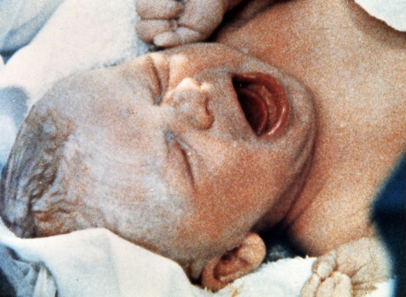 Meilenstein der Medizingeschichte: Louise Brown, das erste Retortenbaby der Welt.