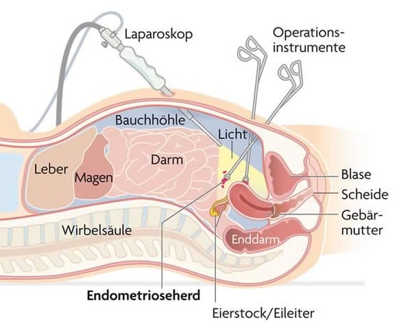 Bei der Bauchspiegelung führen Ärzte eine Kamera in die Bauchhöhle ein.