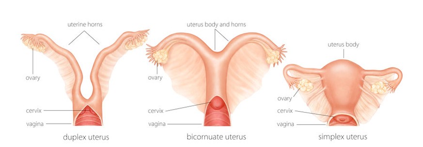 Der doppelte Uterus und der Uterus bicornis im Vergleich zur «normalen» Gebärmutter.