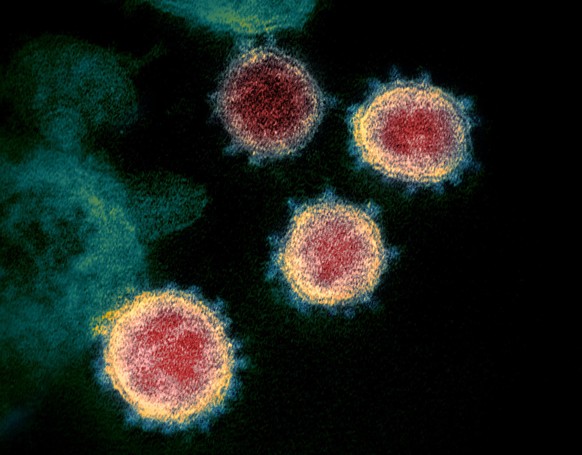Cette photo prise au microscope montre le Sars-Cov-2 (en jaune) d'un patient aux Etats-Unis, émergeant de la surface des cellules.