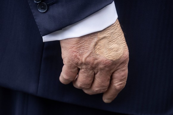 Depuis son entrée en fonction en janvier, le président est apparu avec des bosses et des bleus similaires sur la main presque chaque mois.