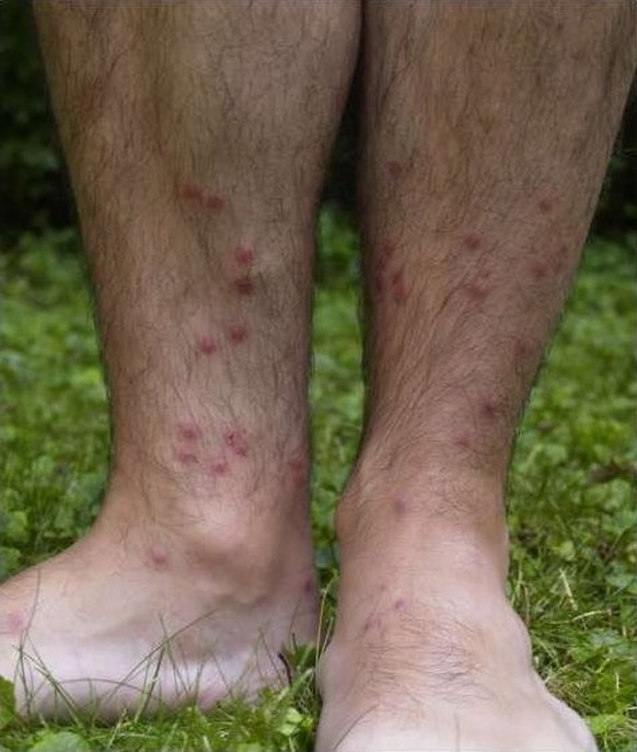 Des boutons de puces de canard sur des jambes