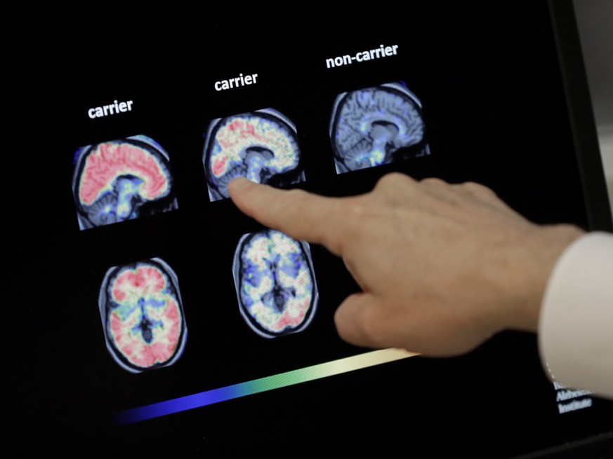 La maladie d'Alzheimer est la forme la plus courante de d