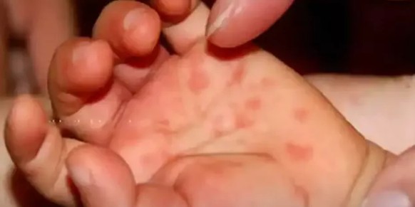 En presque quatre semaines à Kerala, en Inde, plus de 80 bébé ont succombé à la très contagieuse grippe de la tomate. Si aucun virologue n&#039;en connaît la cause, certains éléments précis ont tout d ...