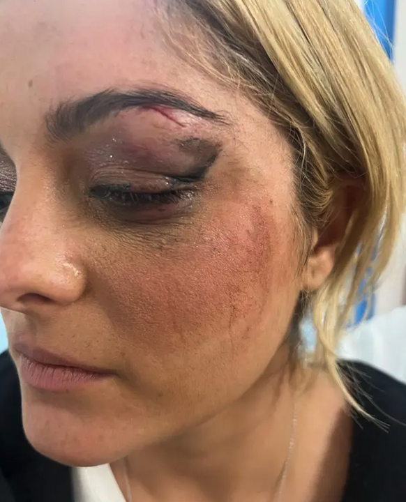 Bebe Rexha ne se laisse pas abattre malgré un oeil poché.