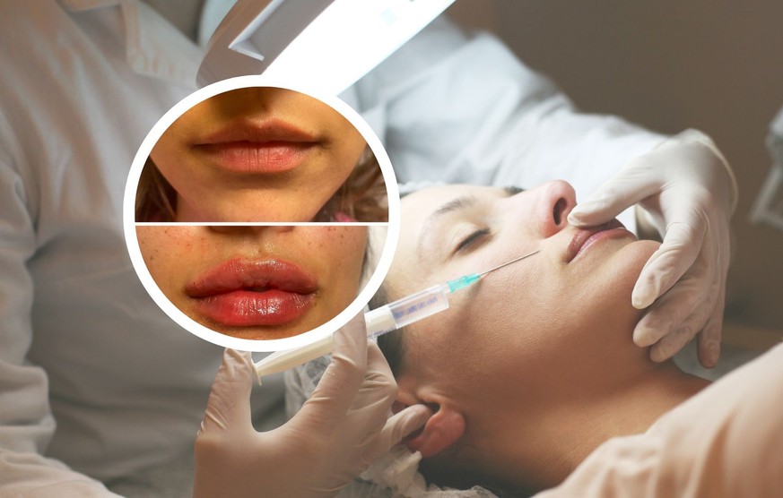 Injections illégales de Botox en Suisse: «Cette impunité me révolte»