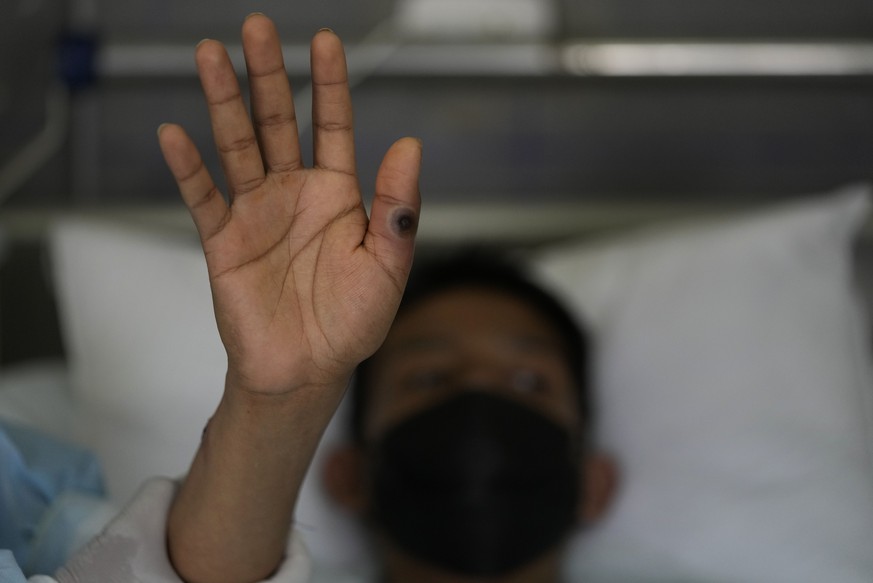 A patient shows his hands with a sore caused by monkeypox at the Arzobispo Loayza hospital in Lima, Peru, Tuesday, Aug. 16, 2022. (AP Photo/Martin Mejia)