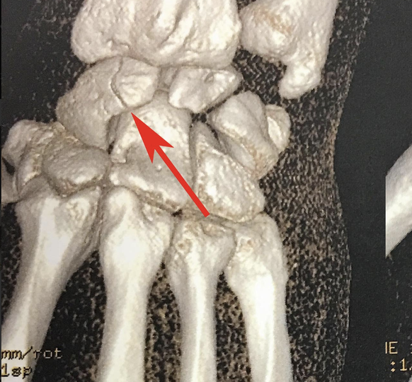 Exemple de fracture du scaphoïde.