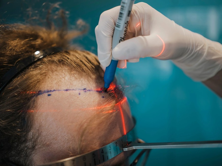 La zone destinée à la greffe est marquée avec une précision millimétrique.