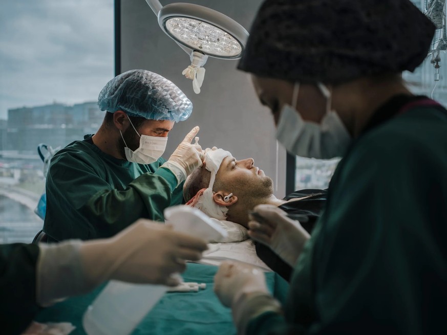 Les médecins implantent les greffons un par un dans le cuir chevelu.