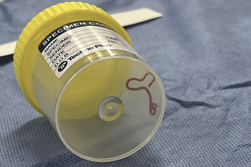This undated photo supplied by Canberra Health Services, shows a parasite in a specimen jar at a Canberra hospital in Australia. A neurosurgeon investigating a patient&#039;s mystery neurological symp ...