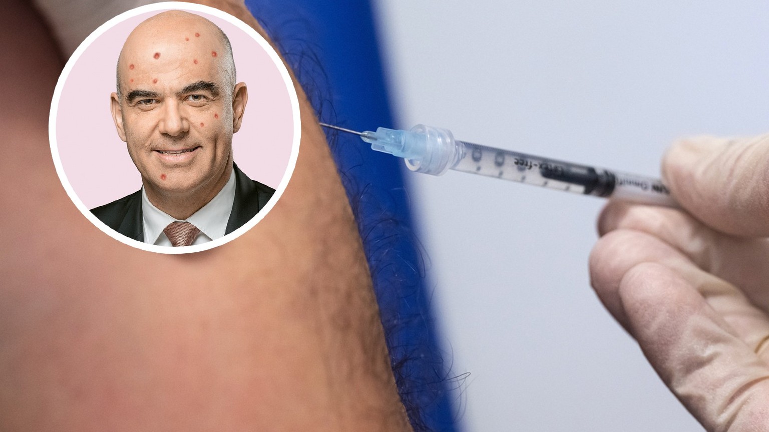 Pourquoi la Suisse n&#039;a pas de vaccin contre la variole du singe