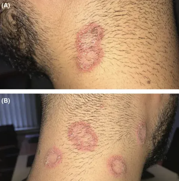 De plus en plus de dermatologues signalent des infections cutanées fongiques chez des patients qui se sont rendus dans un barber shop. Ils conseillent de se faire traiter au plus vite.