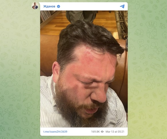 This image provided by Navalny Team on its Telegram channel shows the injuries sustained by Leonid Volkov, an ally and top strategist of the late opposition leader Alexei Navalny, after he was attacke ...