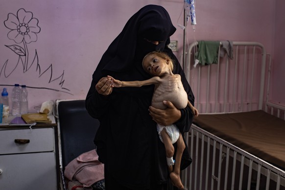 epa12292330 Sham Qudeih, a two-year old Palestinian child, is held by her mother at the Nasser Hospital in Khan Younis, southern Gaza Strip, 10 August 2025. Sham Qudeih suffers from liver enlargement, ...