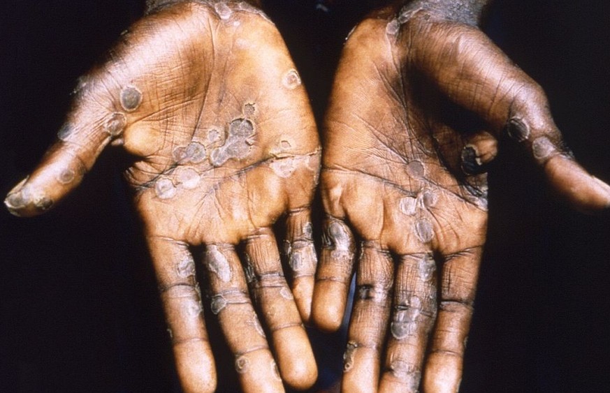 This 1997 image was created during an investigation into an outbreak of monkeypox, which took place in the Democratic Republic of Congo (DRC), formerly Zaire, and depicts the palms of a patient with a ...