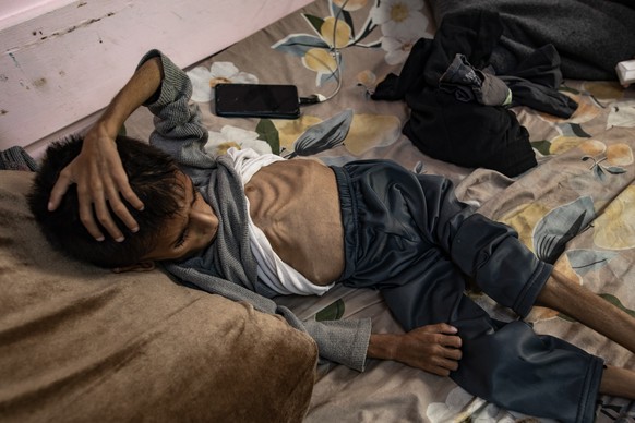 epaselect epa12137109 Five-year-old Palestinian child Osama al-Raqab, who is suffering from severe malnutrition receives treatment at Nasser Hospital in Khan Yunis, southern Gaza Strip, 26 May 2025. E ...