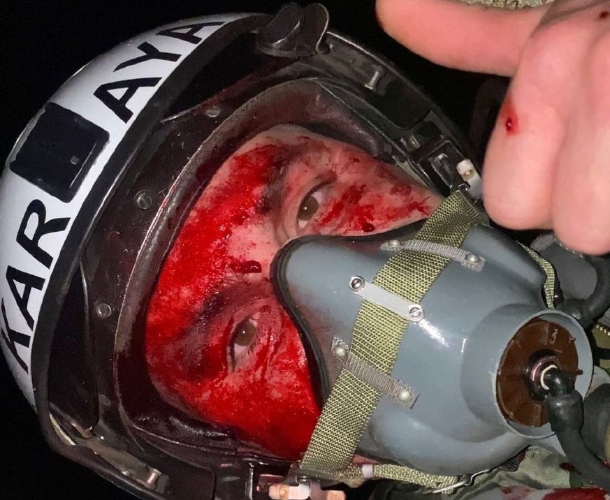 Vadym Voroshylov a été touché au visage par les débris d'un drone russe.