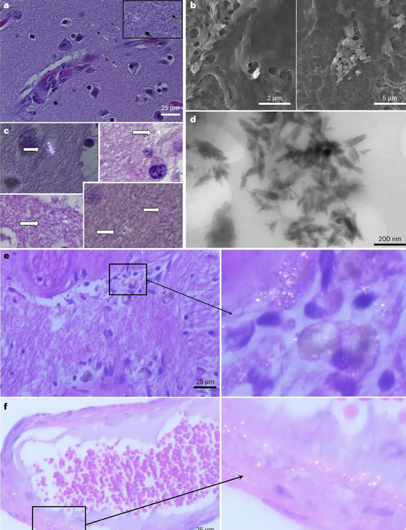 Images au microscope des échantillons de cerveau dans lesquels des microplastiques ont été détectés.