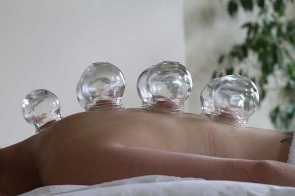 Dr. Xu Hua Han displays the treatment of cupping on a colleague at a treatment centre in London Wednesday, Aug. 10 2016. Cupping is an ancient method of traditional Chinese medicine, where heat or suc ...