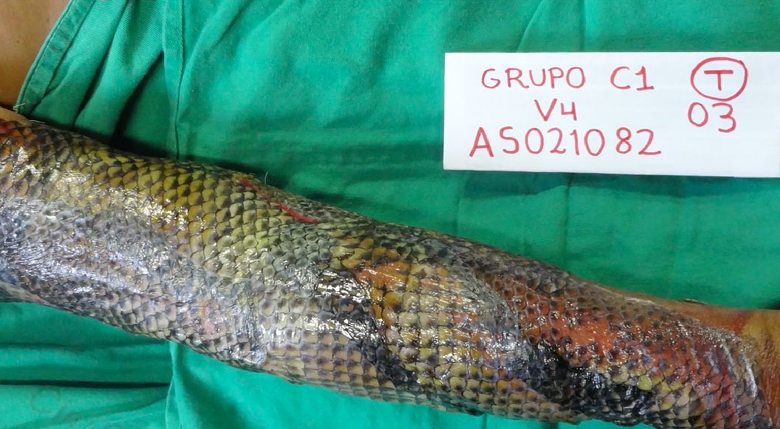 Greffe de peau de Tilapia