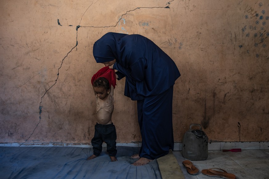 epa12247637 Palestinian child Yazan Abu Foul, aged two, is cared for by his mother Naima, as he suffers from severe malnutrition due to the acute shortage of food caused by the blockade imposed on the ...