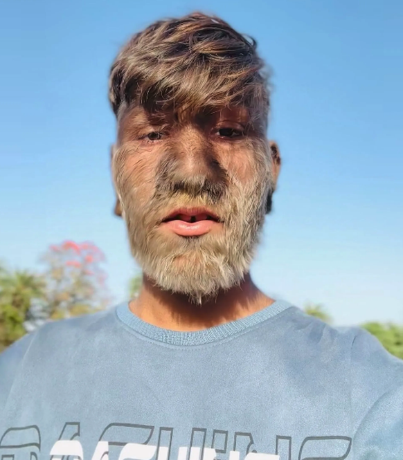 Syndrome du loup-garou: un Indien bat le record du visage le plus poilu