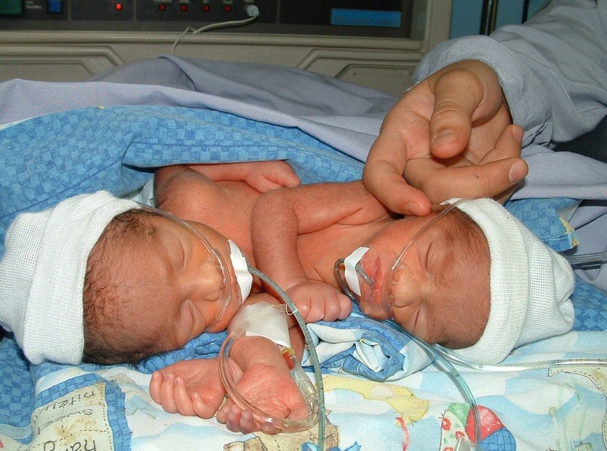 jumeaux siamois Brésil hôpital réalité virtuelle