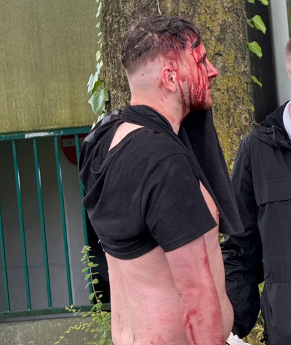 Une photo montre un supporter anglais saignant à la tête.