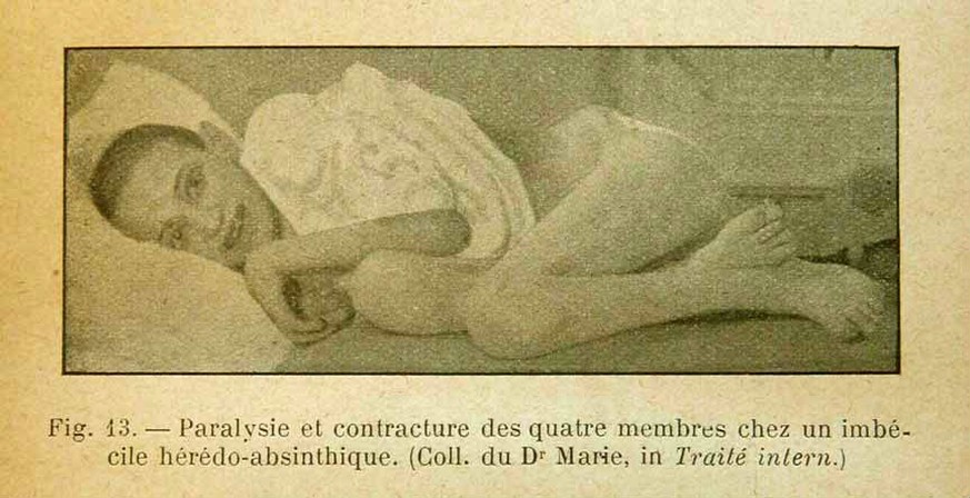 Il était même décrit comment les enfants d'absinthiques subissaient des dommages physiques.
