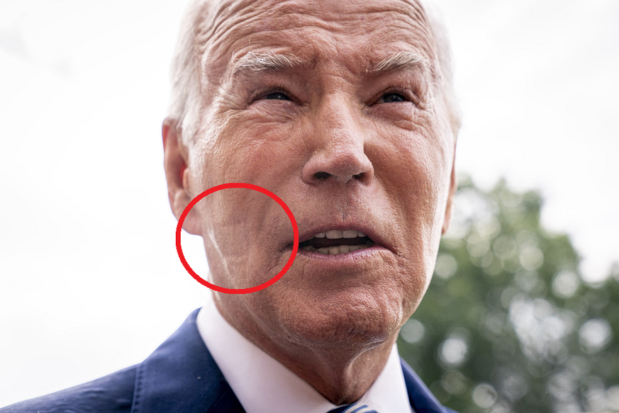 Joe Bident a des marques sur le visage.