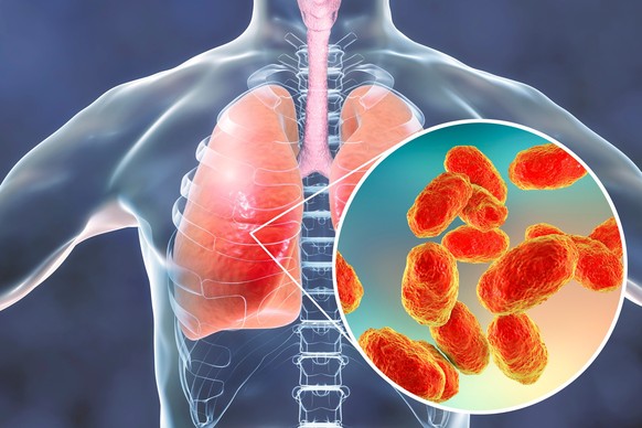 Maladie pulmonaire.