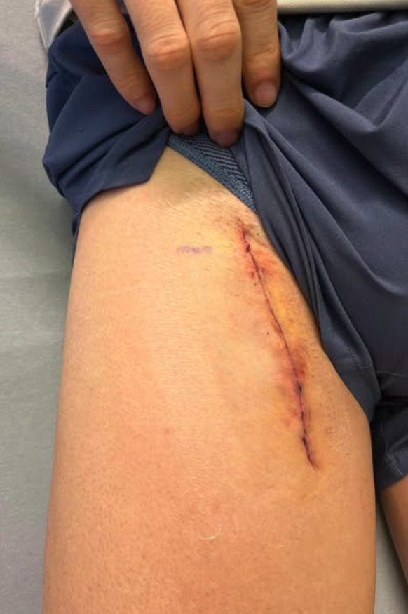 Julien Wanders a eu les deux jambes ouvertes, avec la même cicatrice de chaque côté.