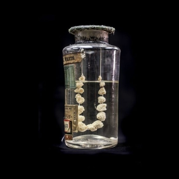 Genitalwarzenkette, Mütter Museum, Philadelphia.⁣
