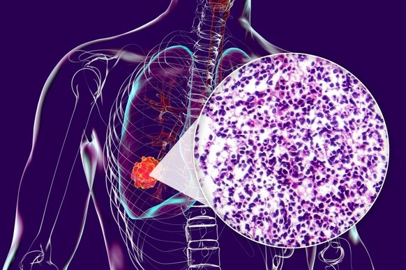 Voici à quoi ressemble le cancer du poumon.
