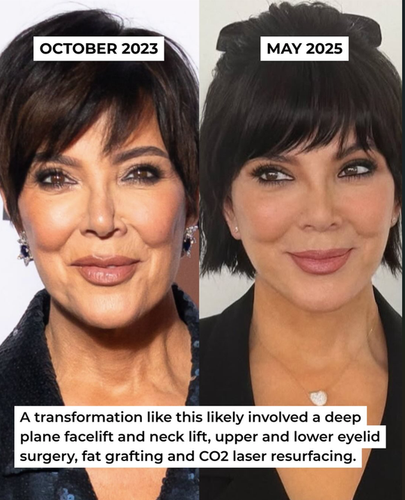 Kris Jenner a eu recours à la chirurgie esthétique