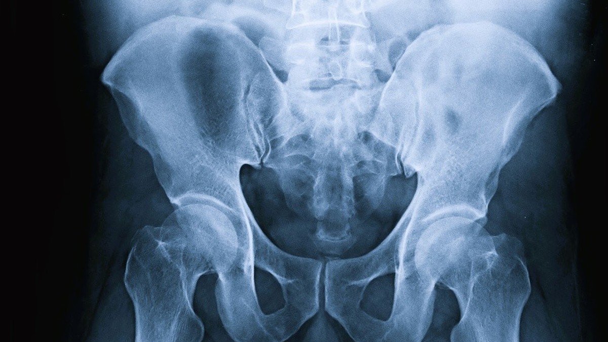 Understanding Osteoporosis: Rennes Hospital Conference on Bone Health