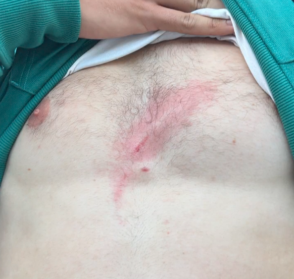 La blessure d'Eric Vanshelboim.