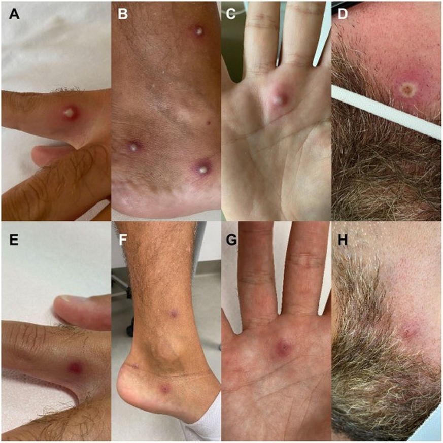 Les lésions du patient, publiées par le Journal of infection.