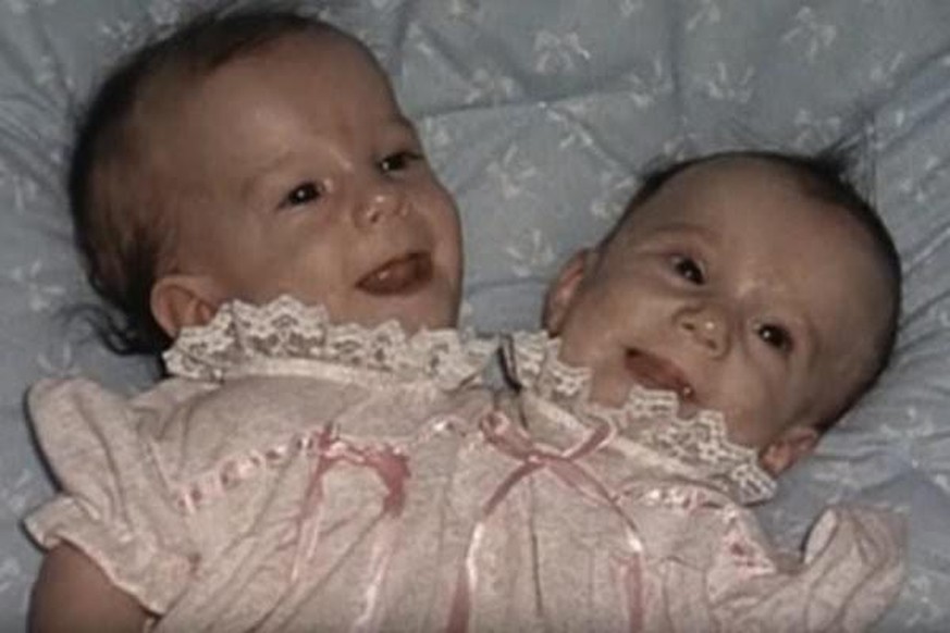 Abby et Brittany lorsqu'elles étaient bébés.