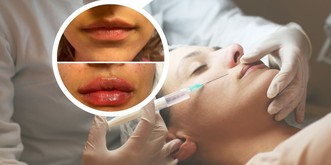 Injections illégales de Botox en Suisse: «Cette impunité me révolte»