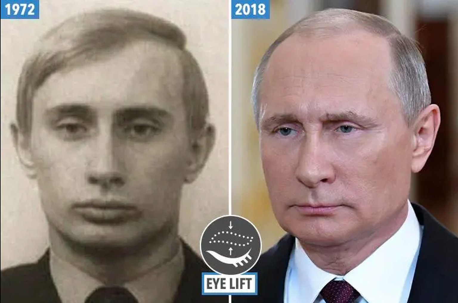 Vladimir Poutine: botox et chirurgie esthétique