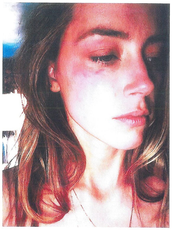 Dieses Foto zeigt die Verletzungen der Schauspielerin Amber Heard, die ihr nach ihrer Aussage von ihrem Ehemann Depp mit dem Handy zugefügt worden sind.