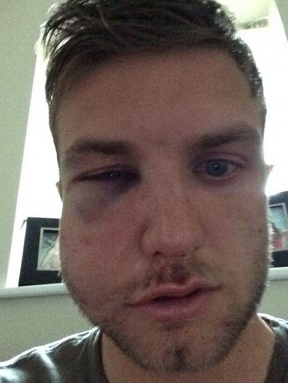 Dieser arme junge Mann ist Doug Loft, Spieler des englischen Drittligisten Port Vale. Bis am Donnerstag zählte der Captain zu den grössten Hoffnungsträgern im Aufstiegsrennen von Port Vale. Doch dann ...