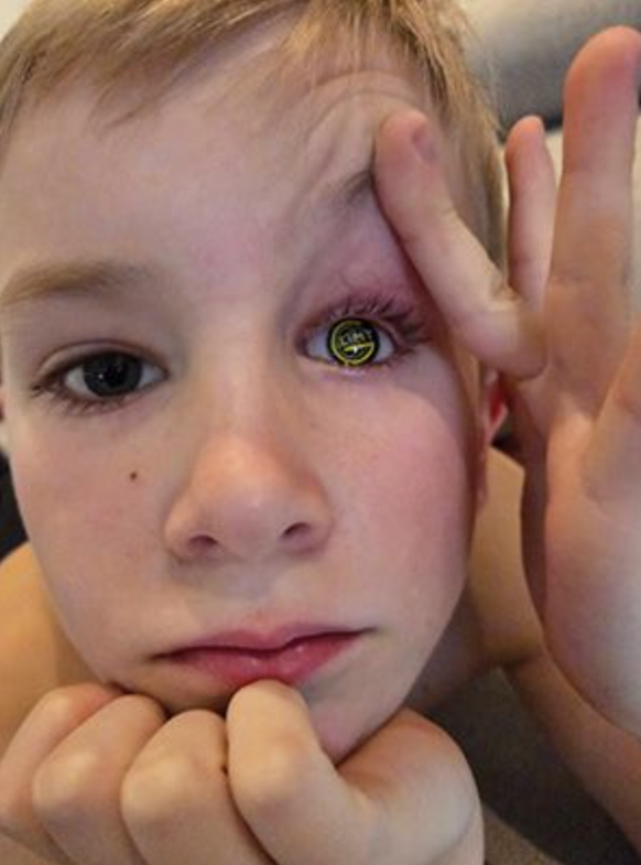 Fredrik mit seiner Augenprothese im Design von Bodö/Glimt.